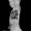 Spine-Lumbar Spine AP-5_21_2012-12_43_29 PM-62.JPEG