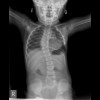 Spine-Lumbar Spine AP-5_21_2012-12_43_31 PM-93.JPEG